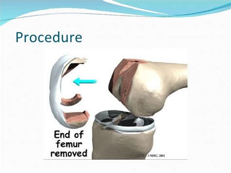 total knee replacement ppt|tkr slideshare.